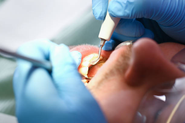 Best Emergency Tooth Extraction in Steiner Ranch, TX