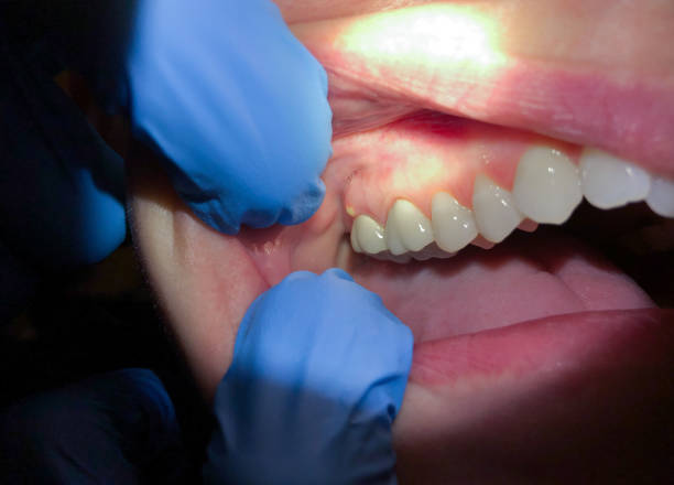 Best Emergency Tooth Extraction in Steiner Ranch, TX